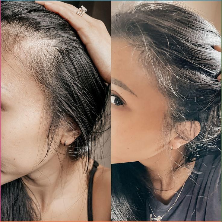 Spray Biotina pentru căderea părului